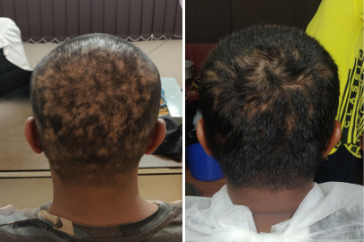 hair fall ayurvedic treatment