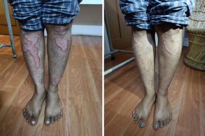 best skin disease treatment bangalore