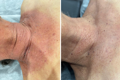 ayurvedic skin treatment