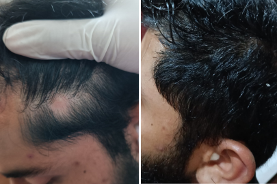 Hair growth ayurvedic