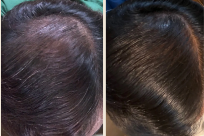 baldness for men